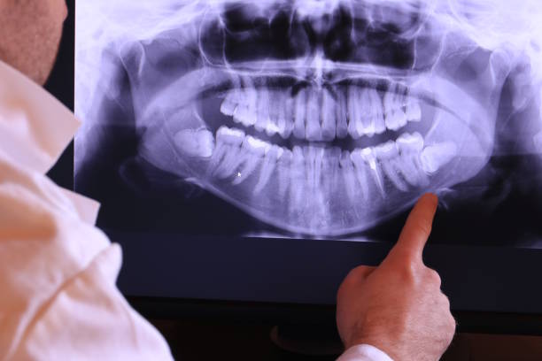 Best Emergency Wisdom Teeth Removal in Llano, TX